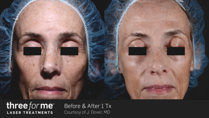 ThreeForMe Before & After J. Dover 1Tx