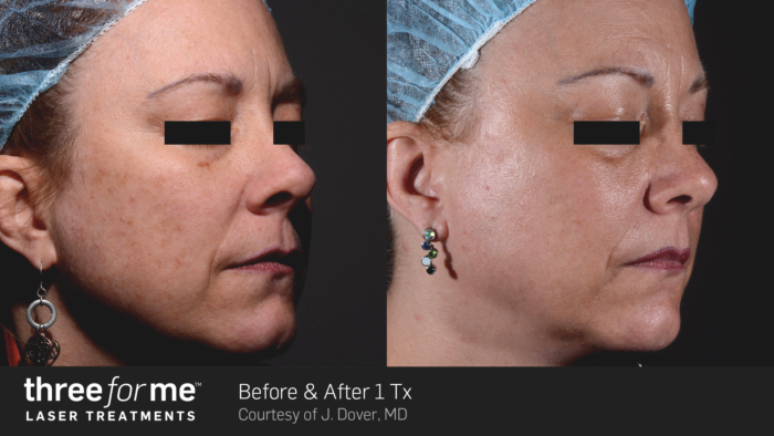 ThreeForMe Before & After J. Dover 1Tx (b)