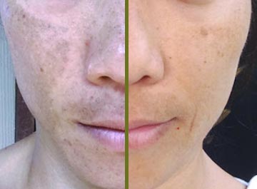 dermatology procedure before and after picture of face