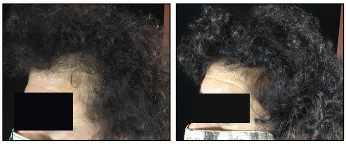 Hair Restoration Before and After