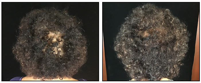 Hair Restoration Before and After - Back of Head