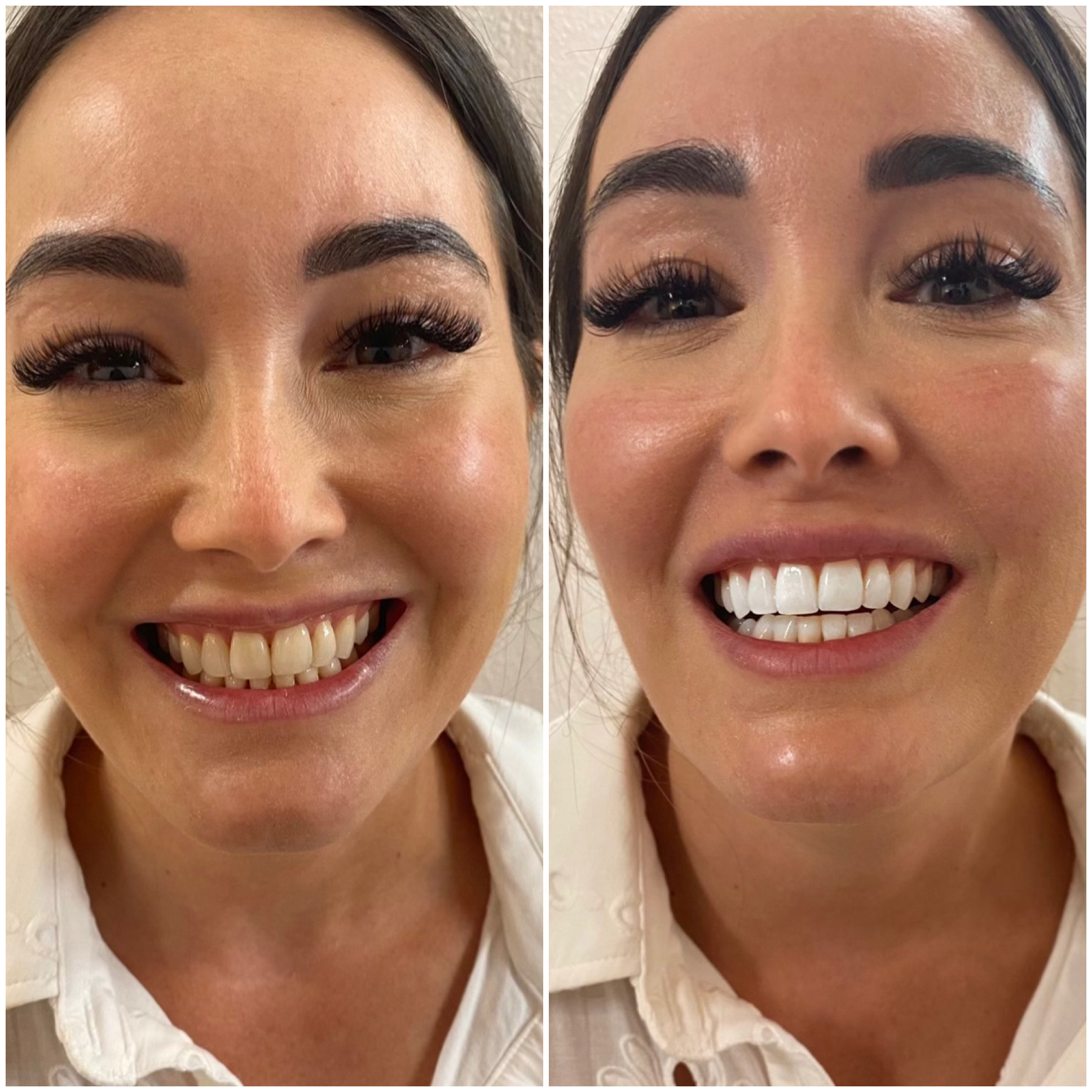 Teeth Whitening before After  