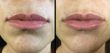 Before After Volbella Lip Texture