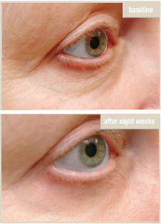 Eye Cream Before After 2 Copy