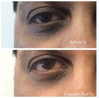 Eye Cream Before After