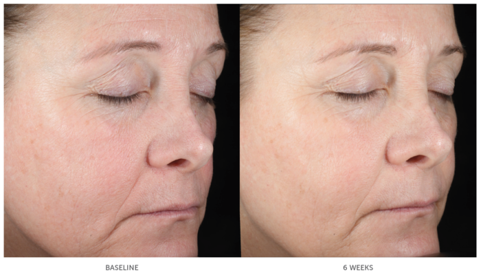 Hydration Serum Before & After - Dr Monica Scheel Dermatology