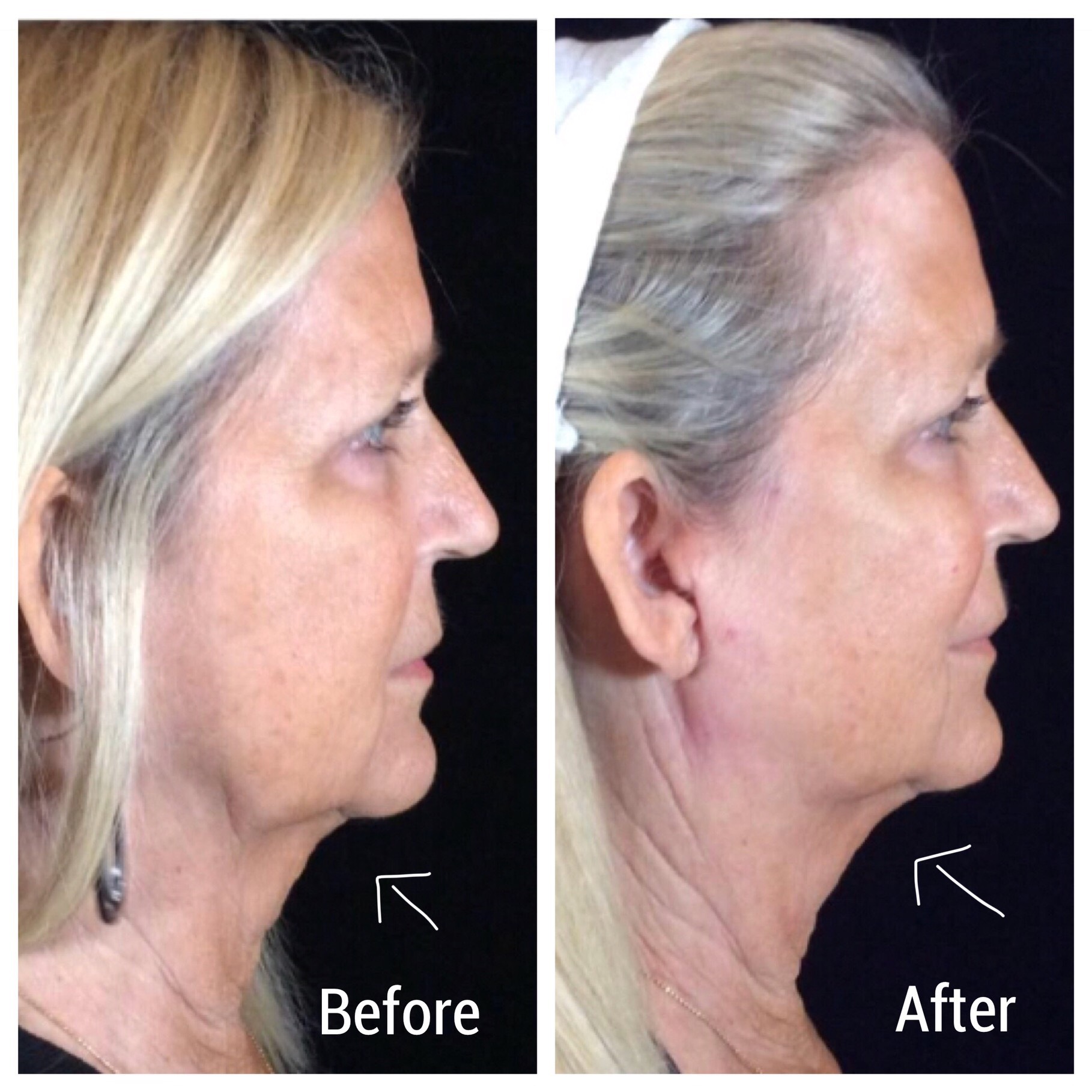 Threads Before And After - Dr Monica Scheel Dermatology