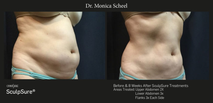SculpSure before/after images Nita Side 2