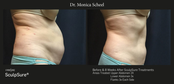 SculpSure Before and After results
