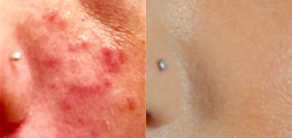 Acne Before After