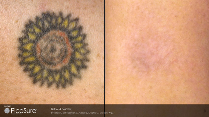 Introducing Laser Tattoo Removal! - Dr Monica Scheel Dermatology, Kailua-Kona, HI