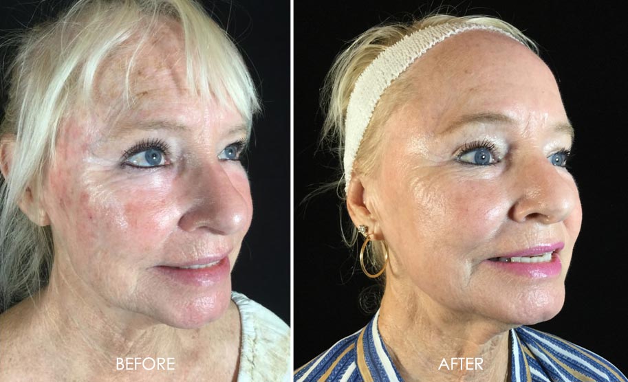 C02 Laser Before After 2 - Dr Monica Scheel Dermatology