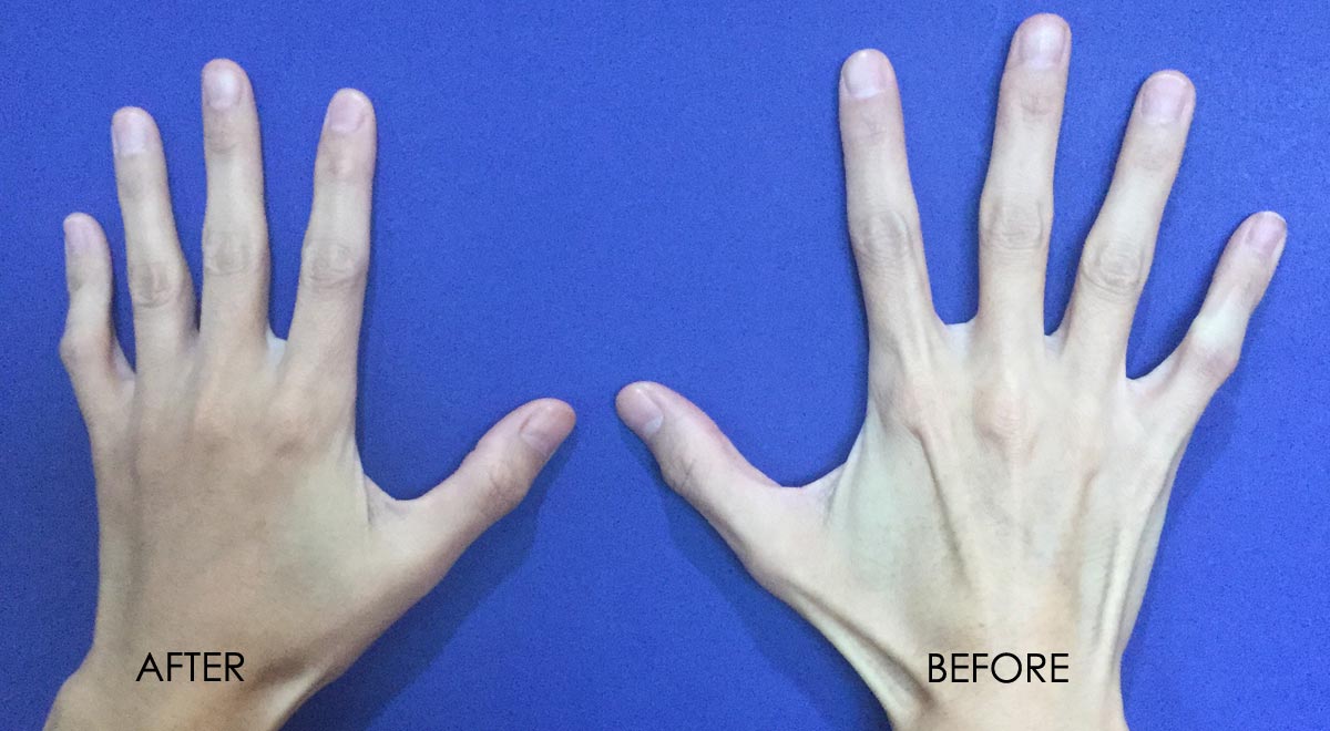 Fillers For Hands 2 - Dr Monica Scheel Dermatology