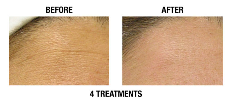 Hydra Facial Wrinkle Reduction