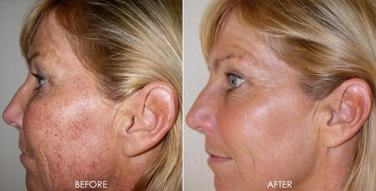 laser-treatments-dr-monica-scheel-dermatology-kailua-kona-hi