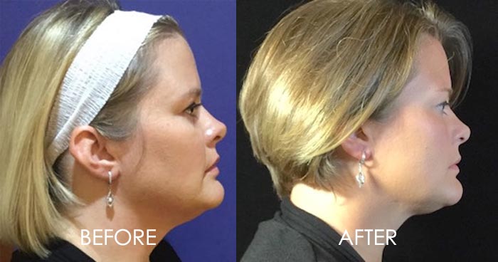 Kybella Before After 3tx
