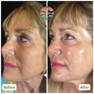 CO2 Laser Skin Resurfacing  Dr Monica Scheel Dermatology, Kailua