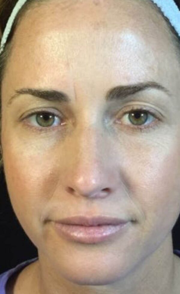 Tca Peels Dr Monica Scheel Dermatology Kailua Kona Hi 4125