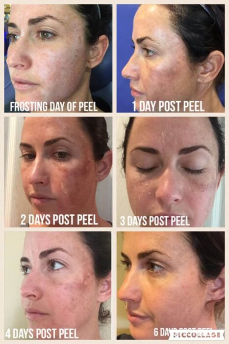 TCA Peels | Dr Monica Scheel Dermatology, Kailua-Kona, HI