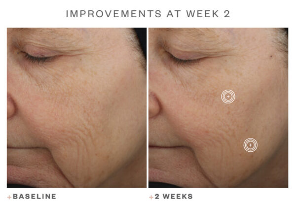 SkinMedica TNS Advanced+Serum Before After 1