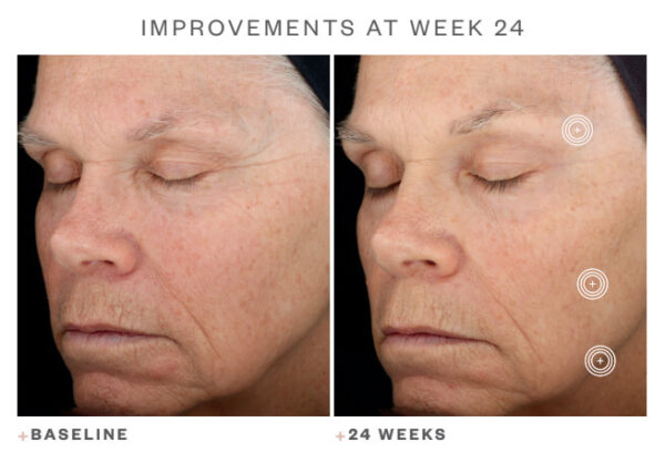 SkinMedica TNS Advanced+Serum Before After 2